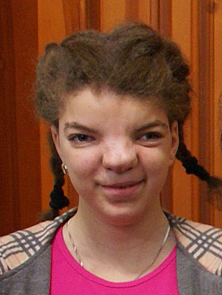 Olesya Kanash mit schweren Gesichtsdeformationen vor der Operation.